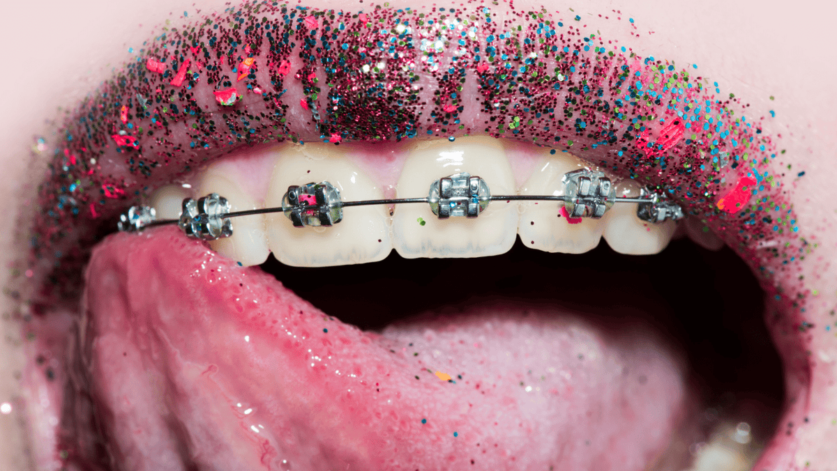 Thinking Of Getting Braces? This Is What You Need To Know.