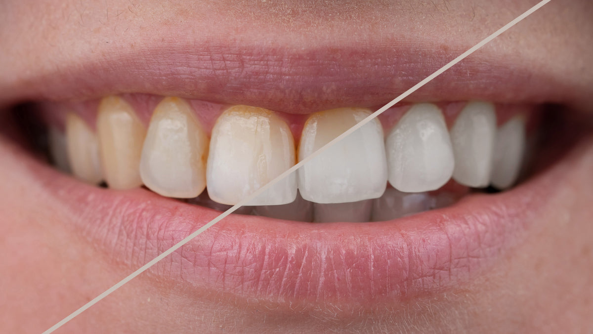 What is Fluorosis and How Can You Avoid It