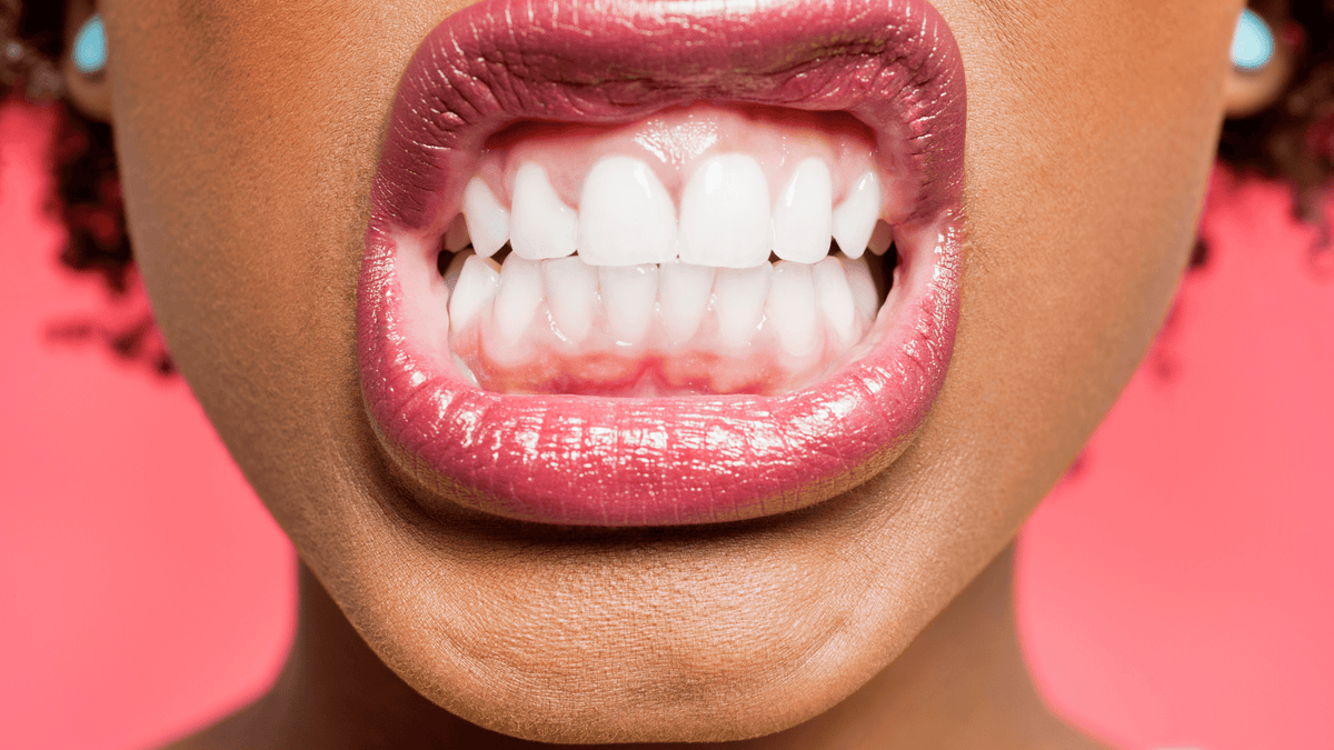 What Are Veneers And Should You Consider Getting Them?