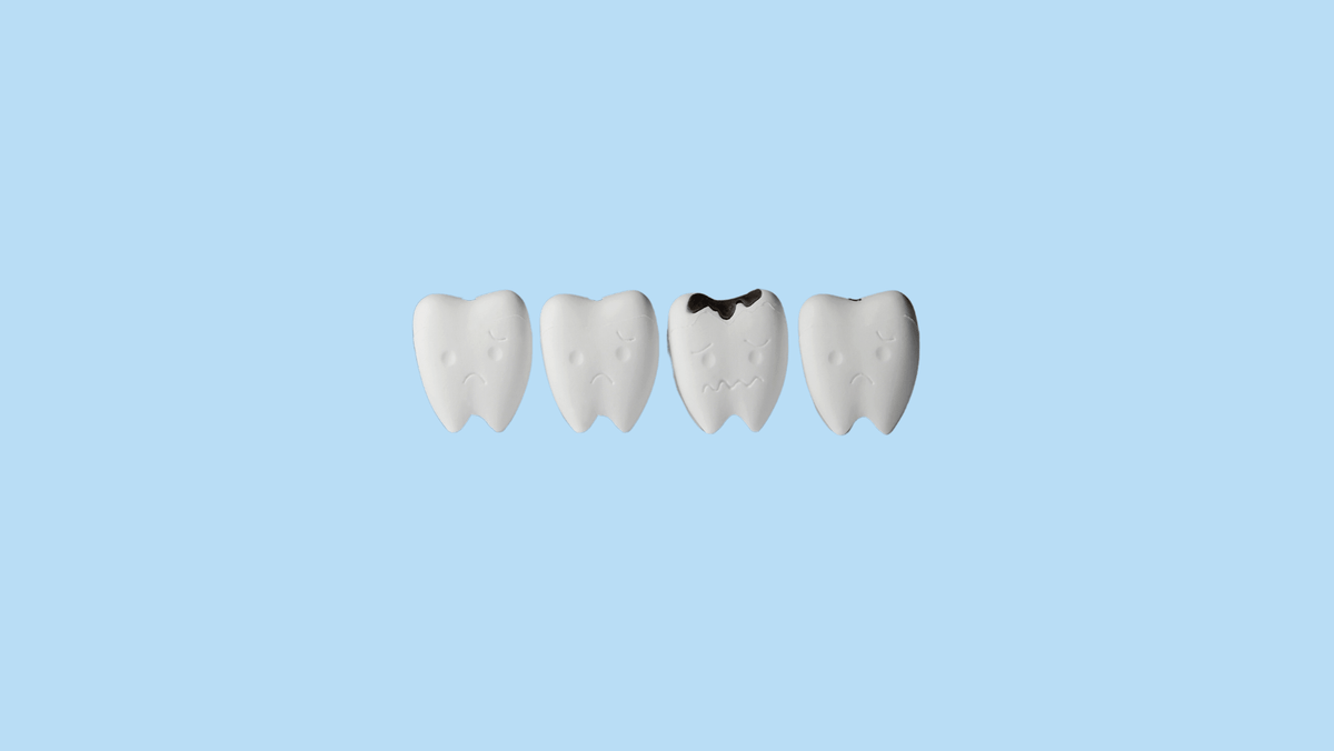 5 Myths about Root Canals